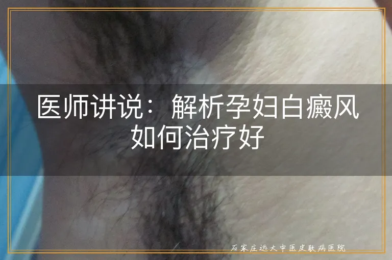 医师讲说：解析孕妇白癜风如何治疗好