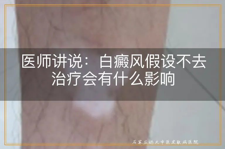 医师讲说：白癜风假设不去治疗会有什么影响