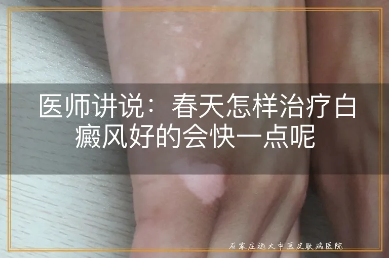 医师讲说：春天怎样治疗白癜风好的会快一点呢