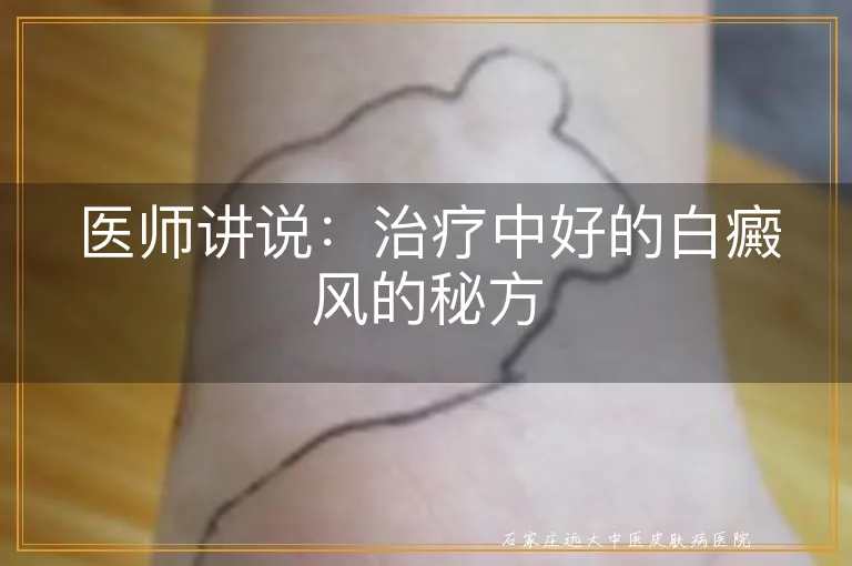 医师讲说：治疗中好的白癜风的秘方