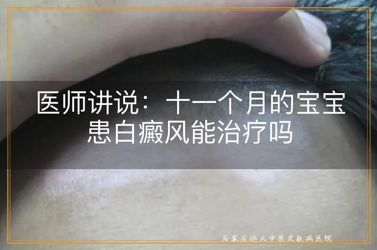 医师讲说：十一个月的宝宝患白癜风能治疗吗