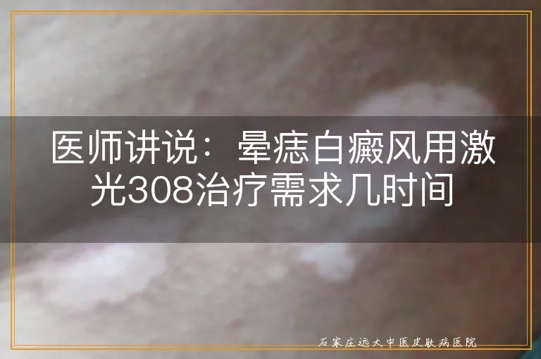 医师讲说：晕痣白癜风用激光308治疗需求几时间