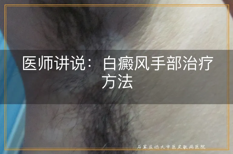 医师讲说：白癜风手部治疗方法