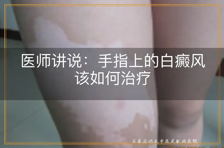 医师讲说：手指上的白癜风该如何治疗