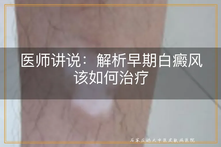 医师讲说：解析早期白癜风该如何治疗