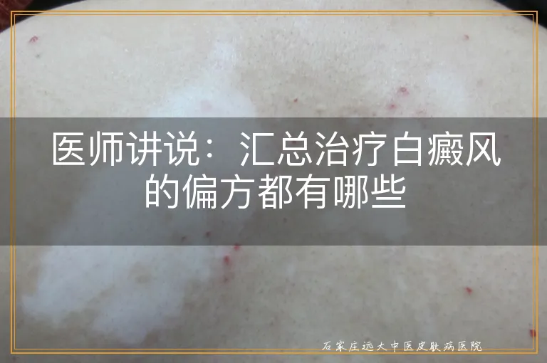 医师讲说：汇总治疗白癜风的偏方都有哪些