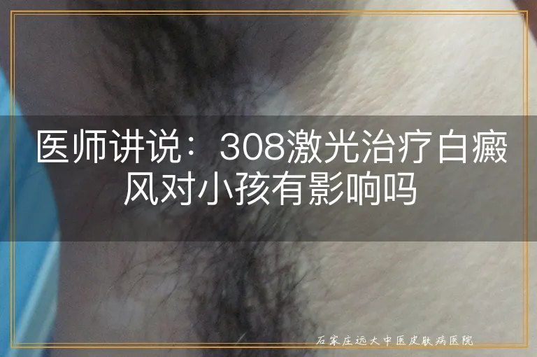 医师讲说：308激光治疗白癜风对小孩有影响吗