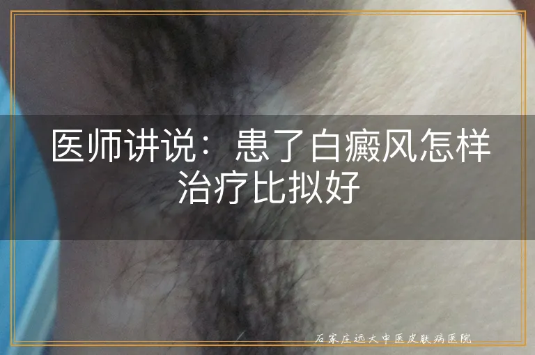 医师讲说：患了白癜风怎样治疗比拟好