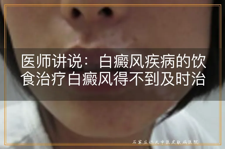 医师讲说：白癜风疾病的饮食治疗白癜风得不到及时治疗的损伤有哪些