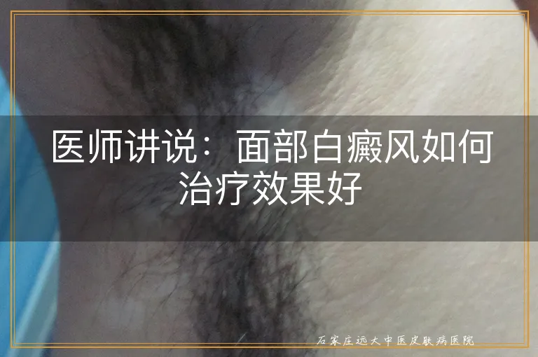 医师讲说：面部白癜风如何治疗效果好