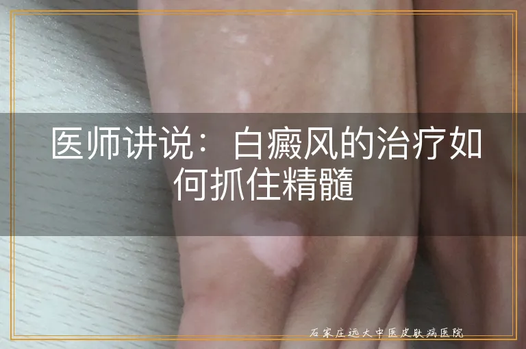 医师讲说：白癜风的治疗如何抓住精髓