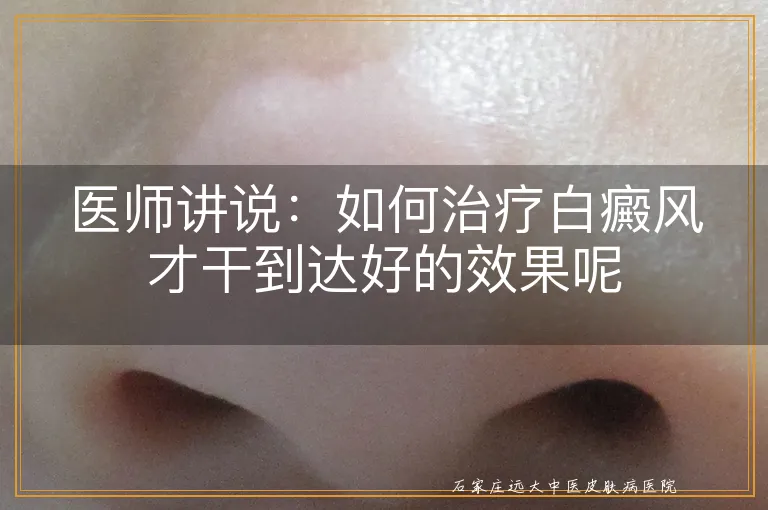 医师讲说：如何治疗白癜风才干到达好的效果呢