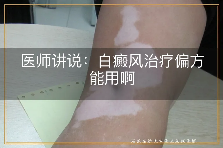 医师讲说：白癜风治疗偏方能用啊