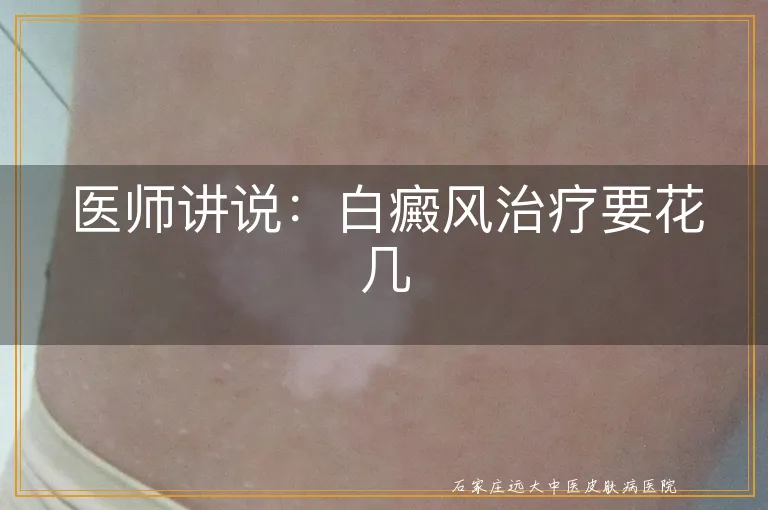 医师讲说：白癜风治疗要花几