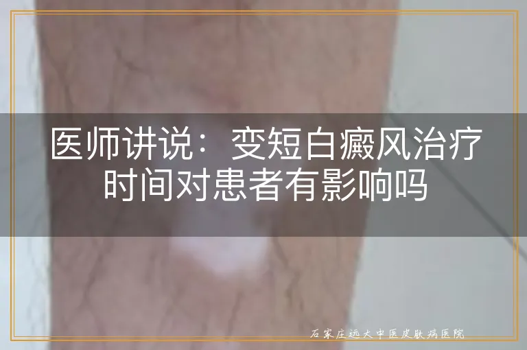 医师讲说：变短白癜风治疗时间对患者有影响吗