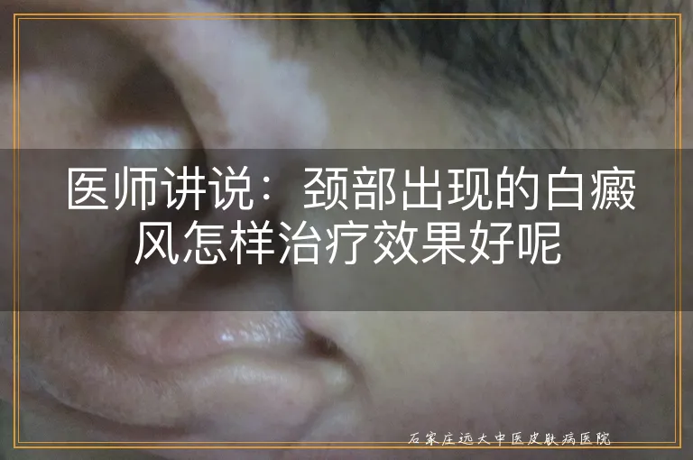 医师讲说：颈部出现的白癜风怎样治疗效果好呢