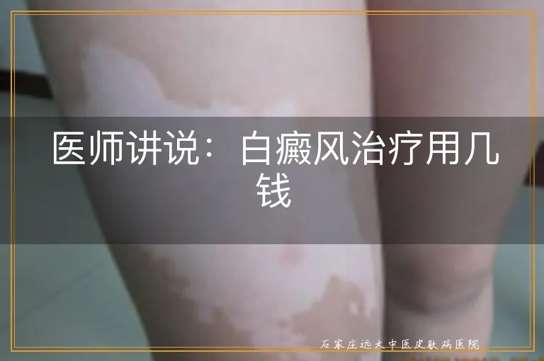 医师讲说：白癜风治疗用几钱