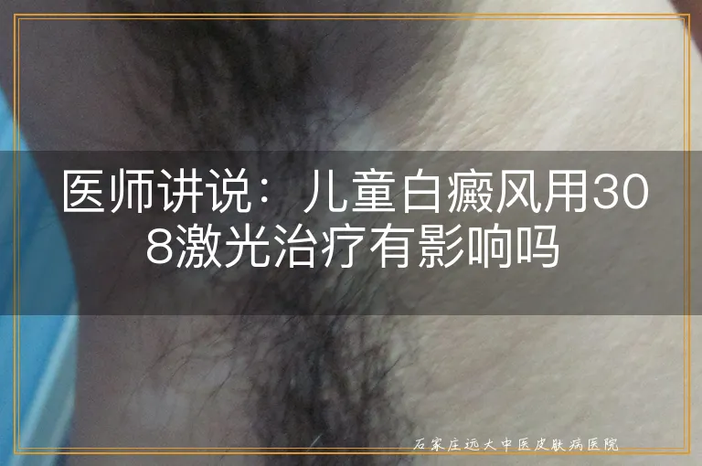 医师讲说：儿童白癜风用308激光治疗有影响吗