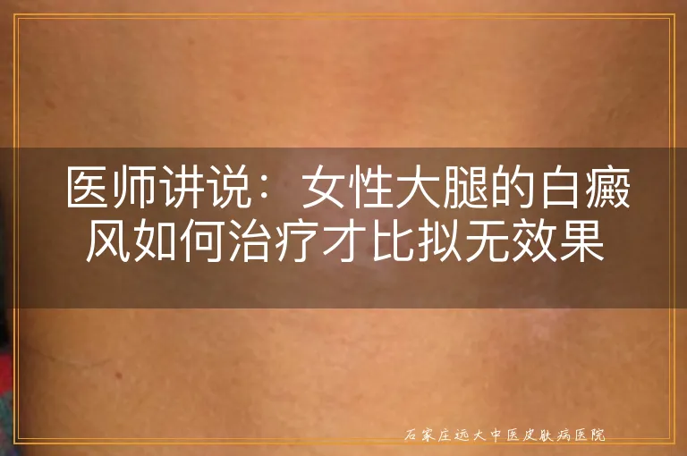 医师讲说：女性大腿的白癜风如何治疗才比拟无效果