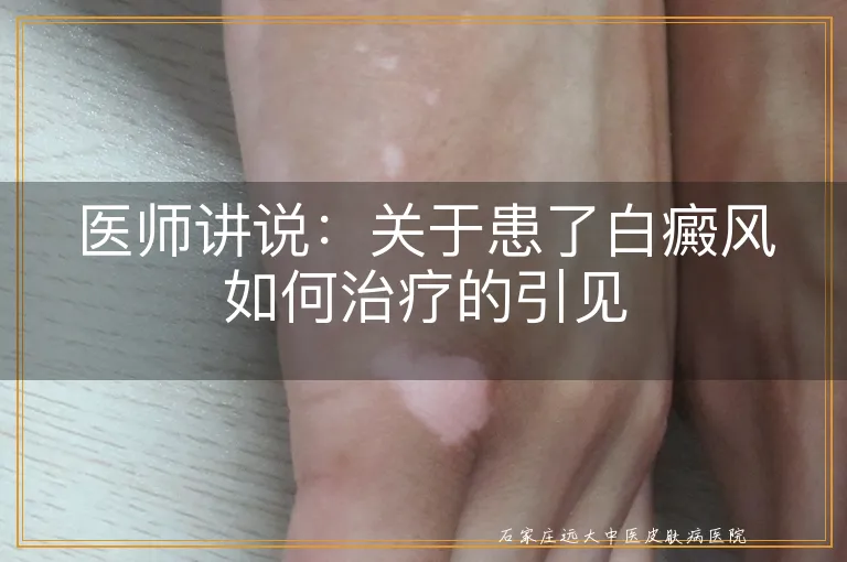 医师讲说：关于患了白癜风如何治疗的引见