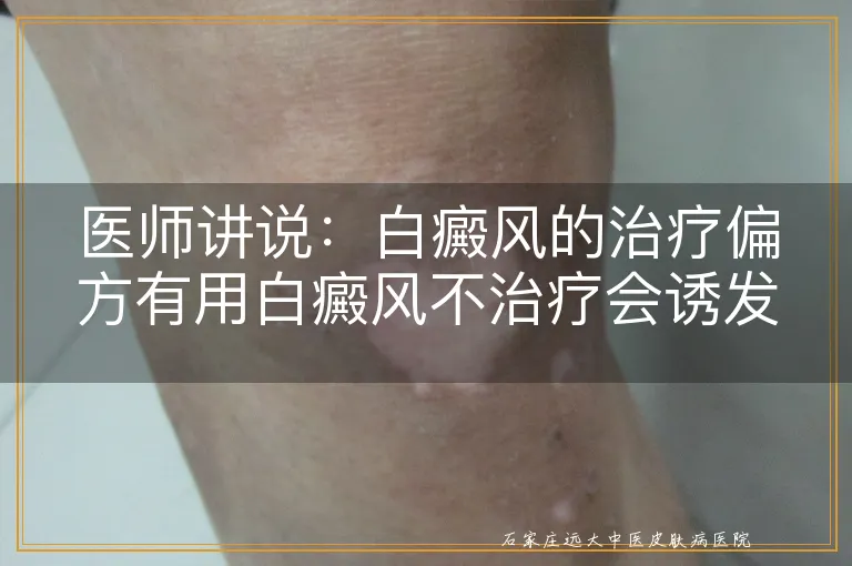 医师讲说：白癜风的治疗偏方有用白癜风不治疗会诱发哪些疾病