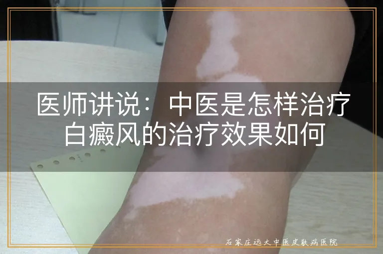 医师讲说：中医是怎样治疗白癜风的治疗效果如何