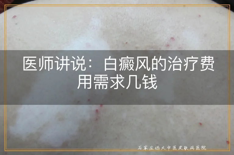 医师讲说：白癜风的治疗费用需求几钱