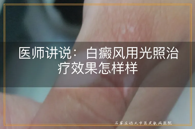 医师讲说：白癜风用光照治疗效果怎样样