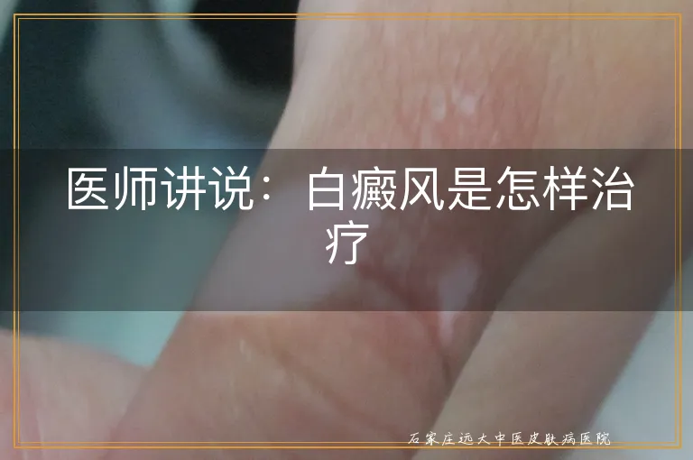 医师讲说：白癜风是怎样治疗