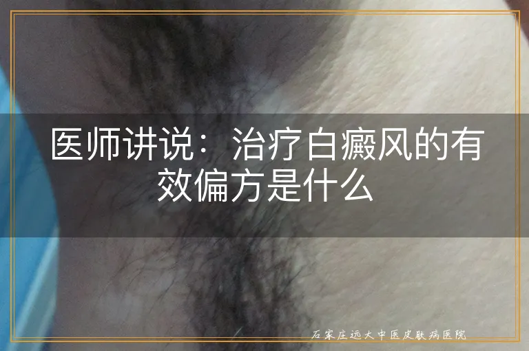 医师讲说：治疗白癜风的有效偏方是什么