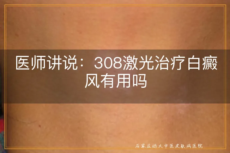 医师讲说：308激光治疗白癜风有用吗