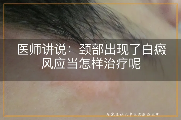 医师讲说：颈部出现了白癜风应当怎样治疗呢