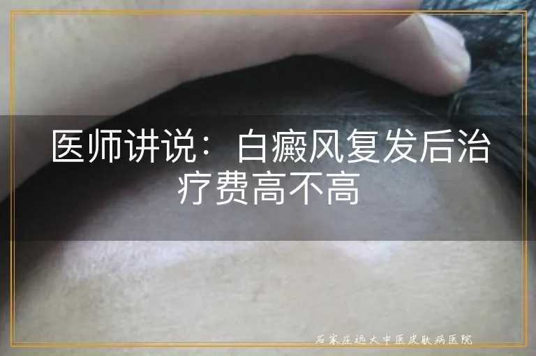 医师讲说：白癜风复发后治疗费高不高