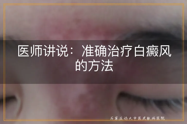 医师讲说：准确治疗白癜风的方法