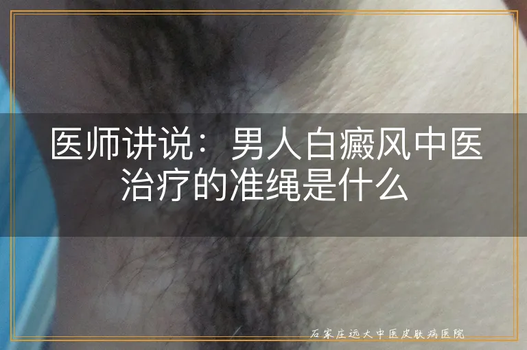 医师讲说：男人白癜风中医治疗的准绳是什么