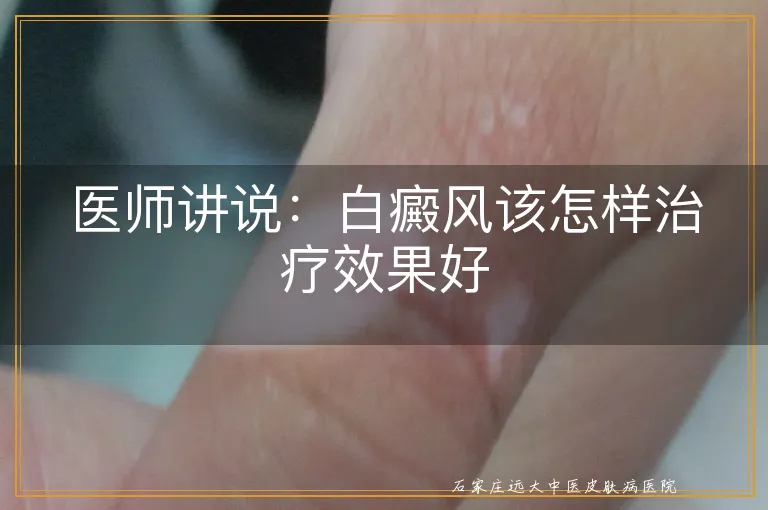 医师讲说：白癜风该怎样治疗效果好