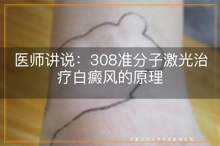 医师讲说：308准分子激光治疗白癜风的原理