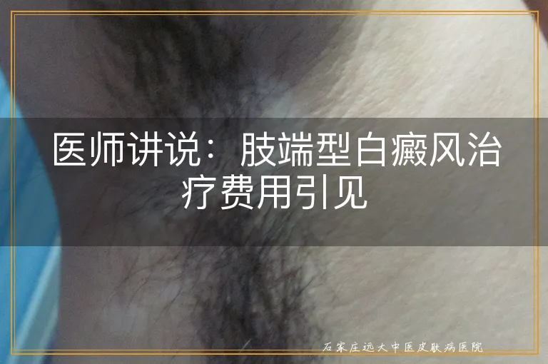 医师讲说：肢端型白癜风治疗费用引见