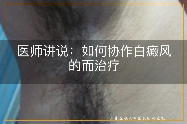 医师讲说：如何协作白癜风的而治疗