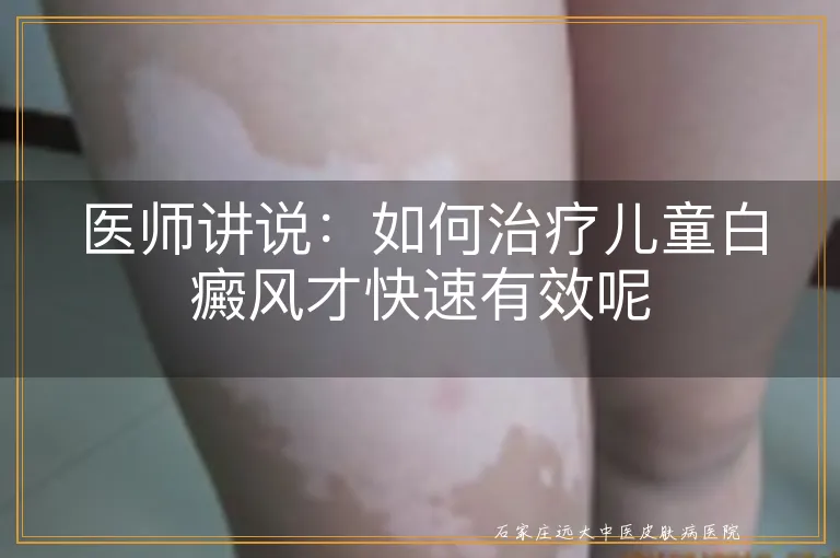 医师讲说：如何治疗儿童白癜风才快速有效呢