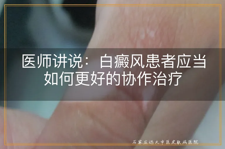 医师讲说：白癜风患者应当如何更好的协作治疗