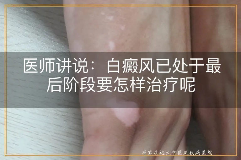 医师讲说：白癜风已处于最后阶段要怎样治疗呢