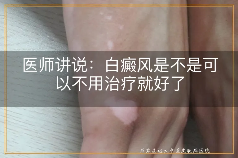 医师讲说：白癜风是不是可以不用治疗就好了