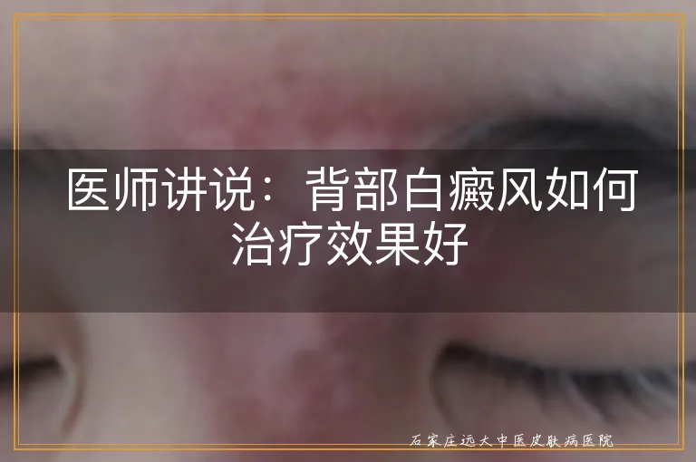 医师讲说：背部白癜风如何治疗效果好