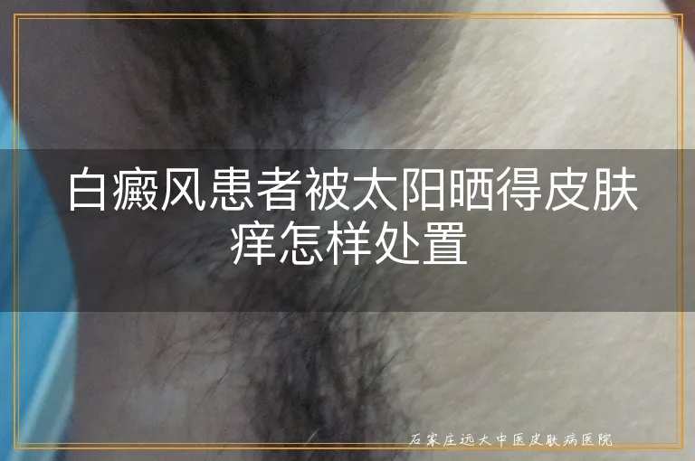 白癜风患者被太阳晒得皮肤痒怎样处置