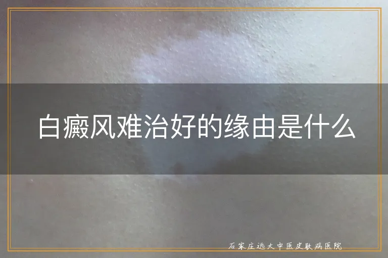 白癜风难治好的缘由是什么