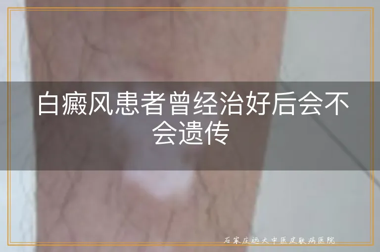 白癜风患者曾经治好后会不会遗传