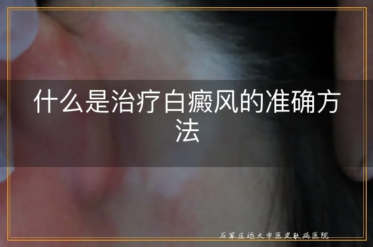 什么是治疗白癜风的准确方法