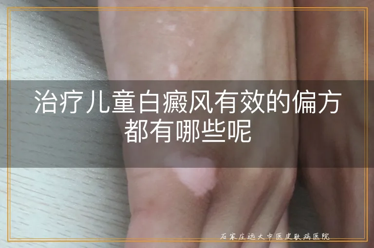 治疗儿童白癜风有效的偏方都有哪些呢