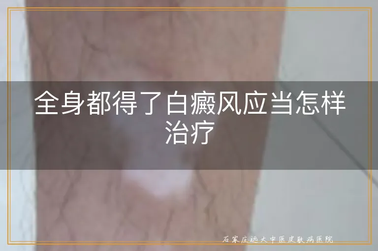 全身都得了白癜风应当怎样治疗